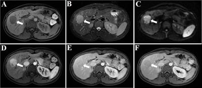 Hepatic perivascular epithelioid cell tumor resembling hepatic adenoma and hepatocellular carcinoma on preoperative imaging: a case report